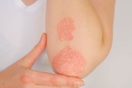 Psoriasis
