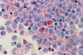 Leucemia Mieloide Aguda