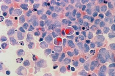 Leucemia Mieloide Aguda