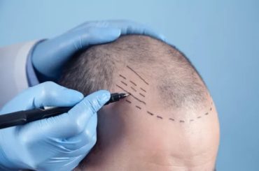 Implantes capilares