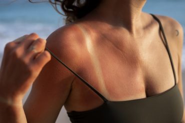 Daños del sol a la piel